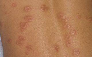 Инфекционный (вирусный) дерматит: фото, причины, симптомы и лечение