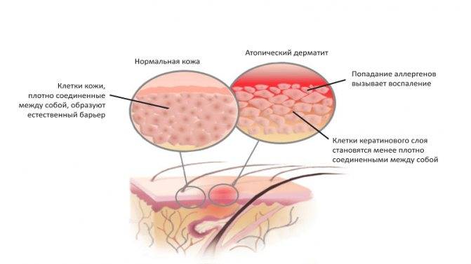 Пузырчатый дерматит: описание и рекомендации к лечению | beauty-love.ru