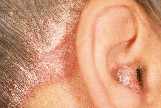 Себорея в ухе: причины появления, симптоматика, лечение