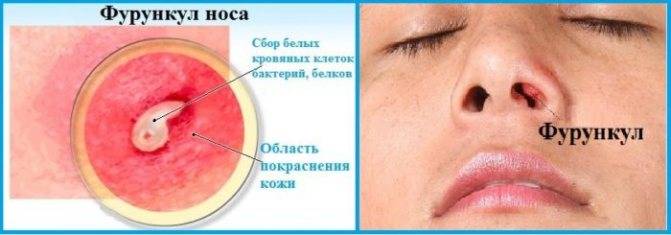 Фурункул на лице: как лечить чирий на подбородке, щеке, губе, брови и во рту? быстрое лечение в домашних условиях | moninomama.ru