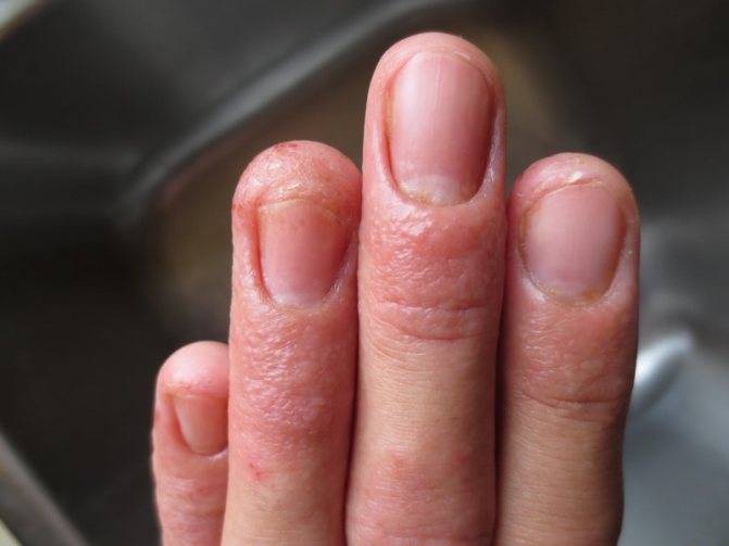 Заболевания ногтей на руках и ногах: фото, названия, описание болезней и их лечение