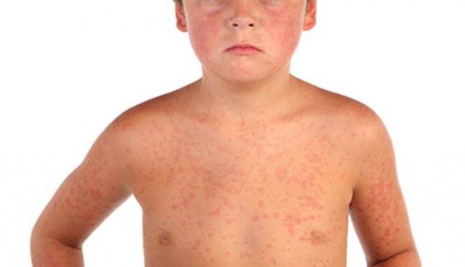 Дерматит инфекционный и вирусный: лечение у детей и взрослых