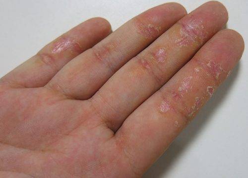 Лечение посттравматической экземы - лечим кожу