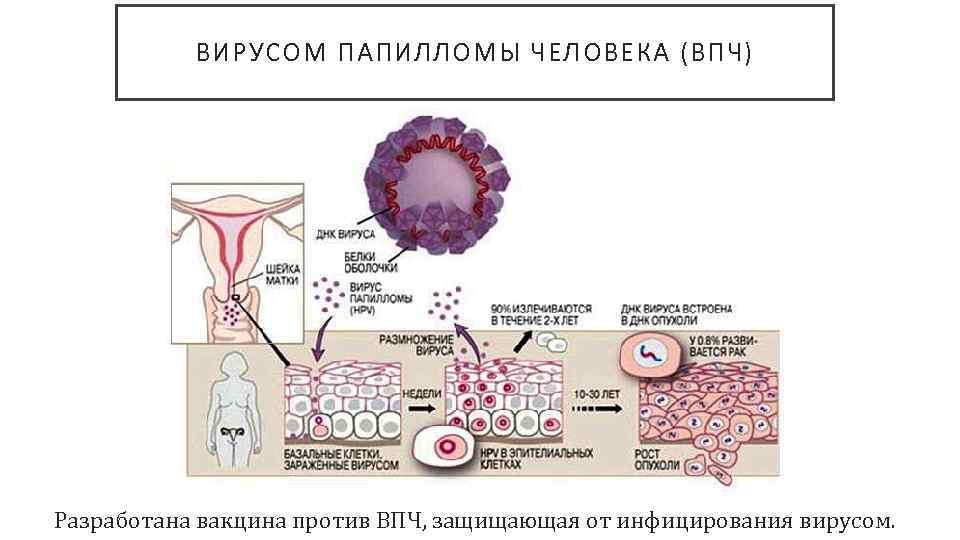 О чем говорит наличие вируса папилломы у женщин в гинекологии
