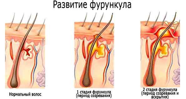 Внутренний фурункул под кожей: общие сведения, лечение и профилактика глубоких чирьев