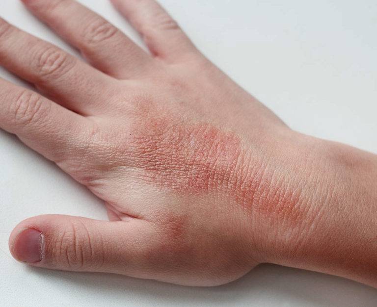 Сухая экзема на руках чем лечить и мазать, симптомы, фото