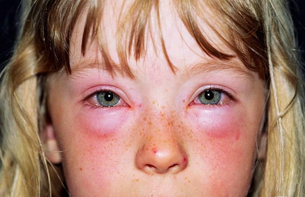 Крапивница на лице — это острая аллергическая реакция! причины возникновения, методы лечения и профилактика возникновения сыпи