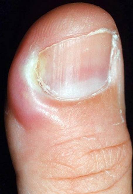 Болезни ногтей: причины, симптомы и лечение
