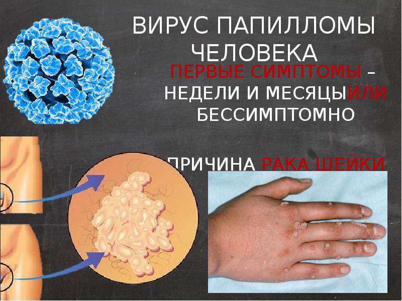 Вирус папилломы человека(впч) в гинекологии