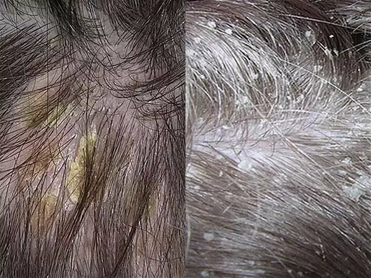 Сухая кожа головы и перхоть: 15 шампуней на волосы - что делать и как избавиться, причины и лечение