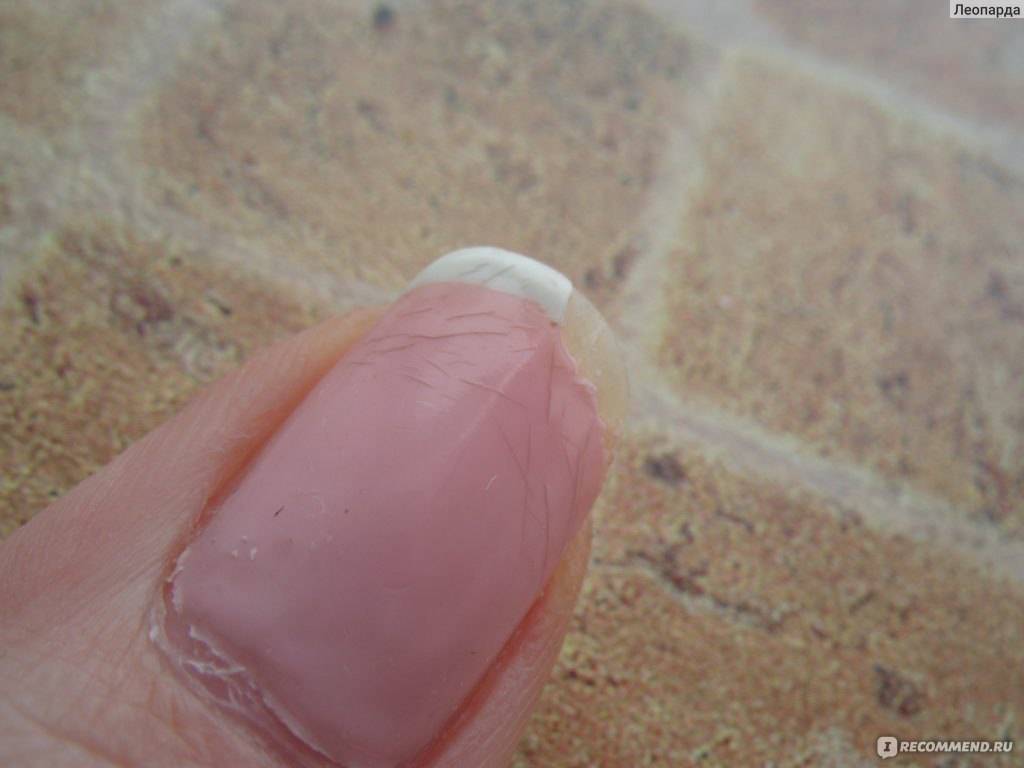 Отслаивание ногтевой пластины – причины и методы возможного лечения