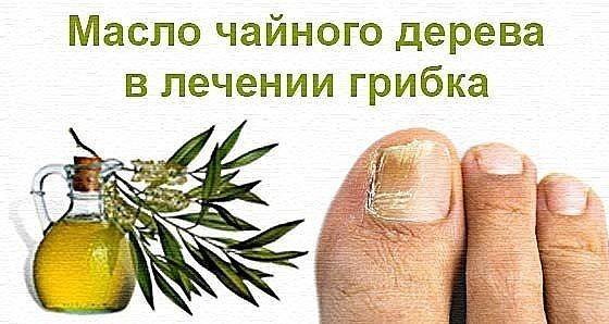 Масло чайного дерева для ногтей на руках и ногах против грибка: можно ли использовать, как лечить инфекцию, и применение эфирных ванночек и иных средств из препарата