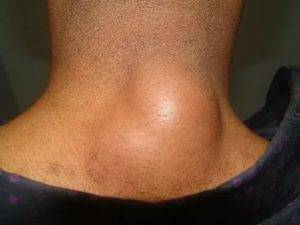 Фурункул на шее: причины появления и чем лечить чирей