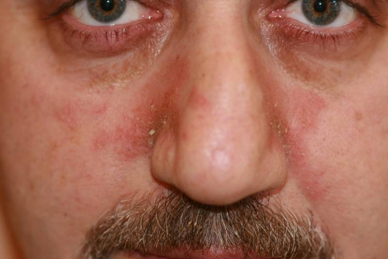 Вирусный (инфекционный) дерматит - первые симптомы, чем и как лечить