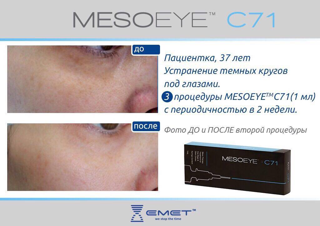 Мезая. Препарат MESOEYE c71. Биоревитализация MESOEYE. Препарат МЕЗОАЙ под глаза. Биоревитализация кожи вокруг глаз MESOEYE c71.