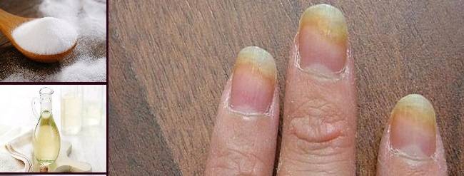 Какие народные средства для лечения грибка ногтей самые эффективные и почему