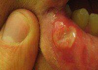 Герпетический стоматит вызывается вирусом герпеса thumbnail
