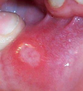 Стоматит на губе у взрослых фото thumbnail
