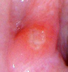 Симптомы герпеса в полости рта