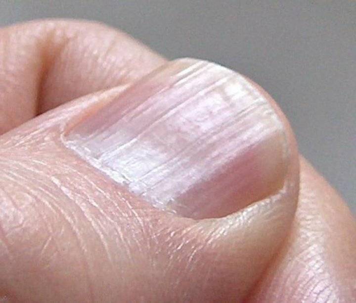 Диагностика здоровья по ногтям пальцев рук. фото