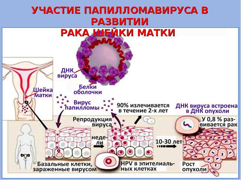 Папиллома в гинекологии — что это, вирус человека, у женщин, причины и лечение, фото
