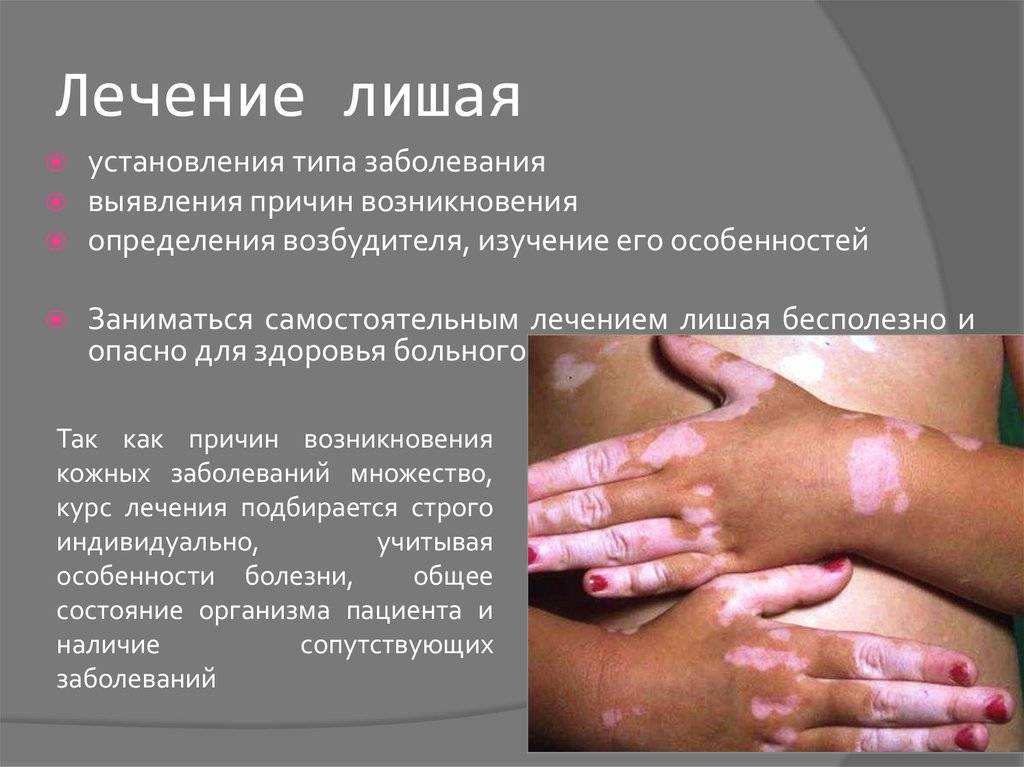 Опоясывающий лишай: фото, что это, как проявляется на теле, на руке, ноге, голове, чем лечить герпес у пожилых | pro-herpes.ru