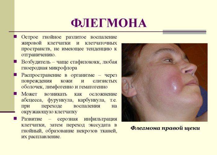Фурункул на лице - как устранить симптомы заболевания?
