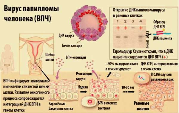 Впч у женщин: типы, симптомы и лечение вируса папилломы человека