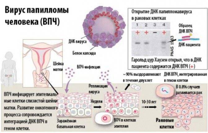 Вирус папилломы человека у женщин в гинекологии: что это такое, фото впч на шейке матки, основные симптомы, а также методы лечения папилломавируса