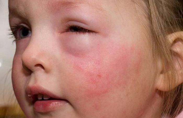 Папулезная крапивница у детей и взрослых: фото, симптомы и лечение | fr-dc.ru