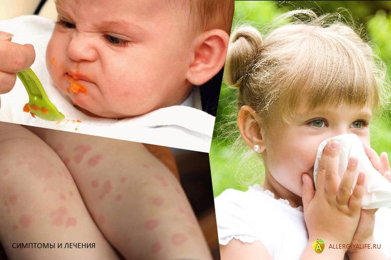 Аллергическая крапивница у детей: фото, симптомы. лечение