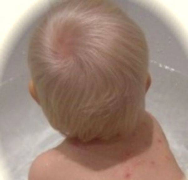 Розовый лишай у ребенка - признаки и симптомы, как лечить пятна на коже, фото