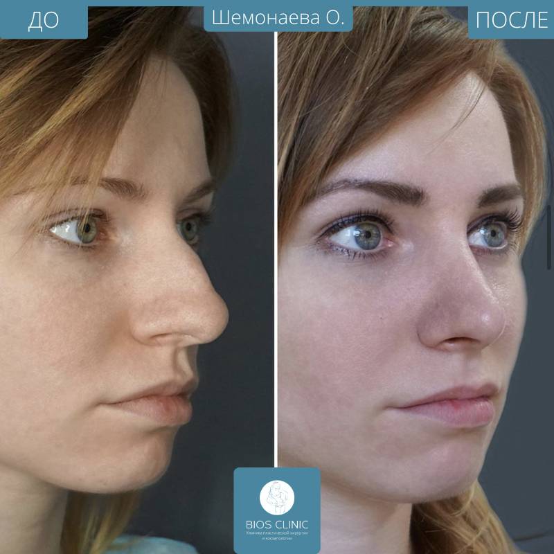 Фото ринопластики до и после нос. Ринопластика. Ринопластика носа. Нос до и после.