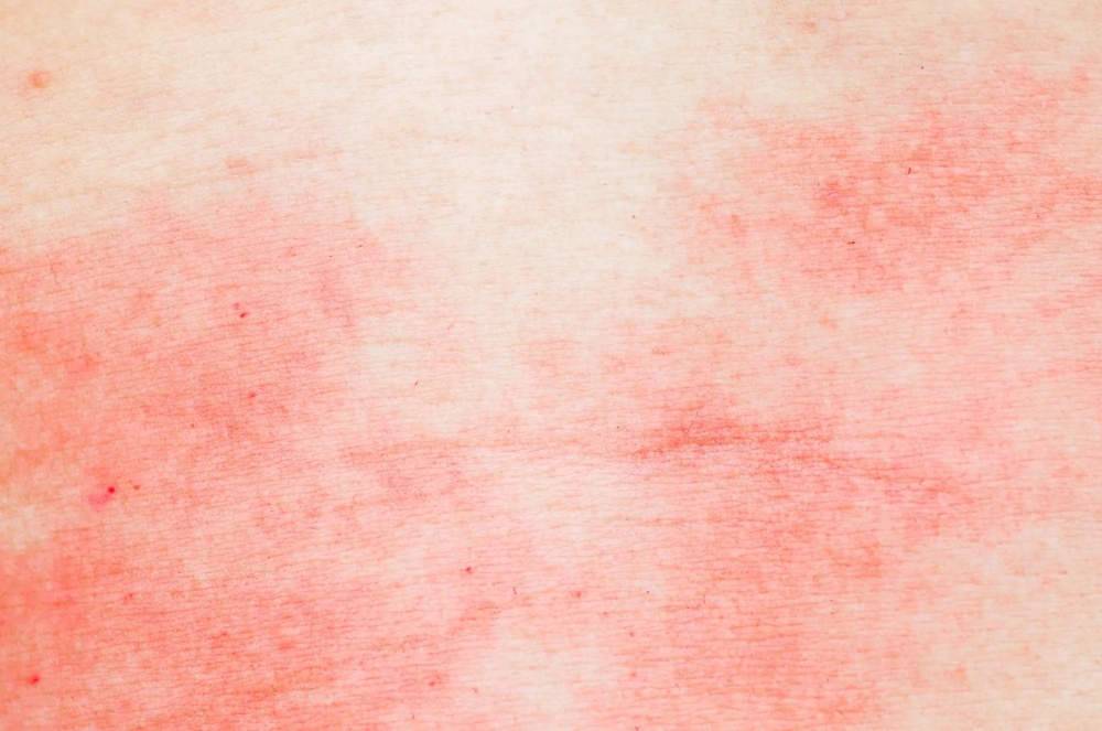 Экзема прямой кишки симптомы - лечим кожу