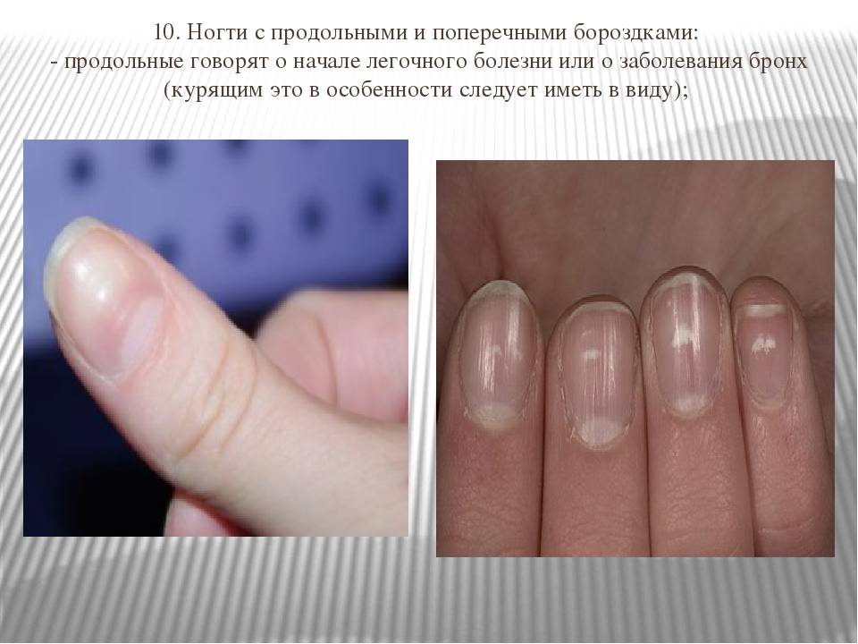 Вмятины и ямки на ногтях: причины, лечение