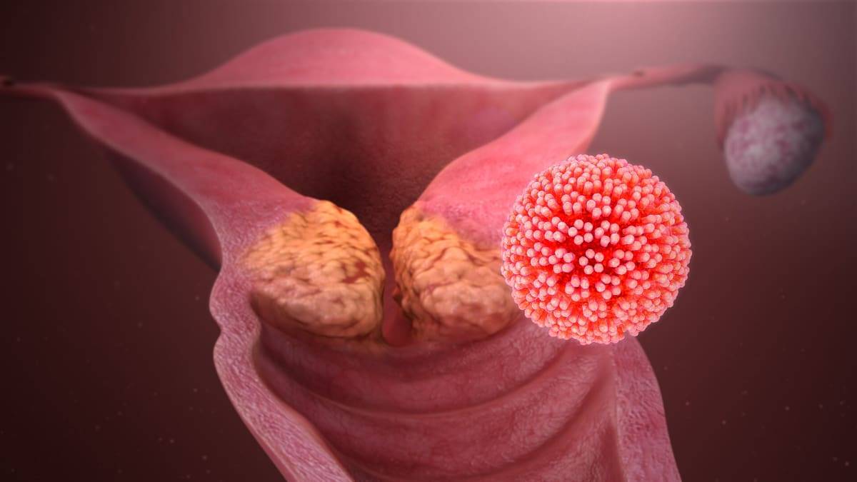Чем страшен вирус папилломы человека у женщин в гинекологии |
            эко-блог