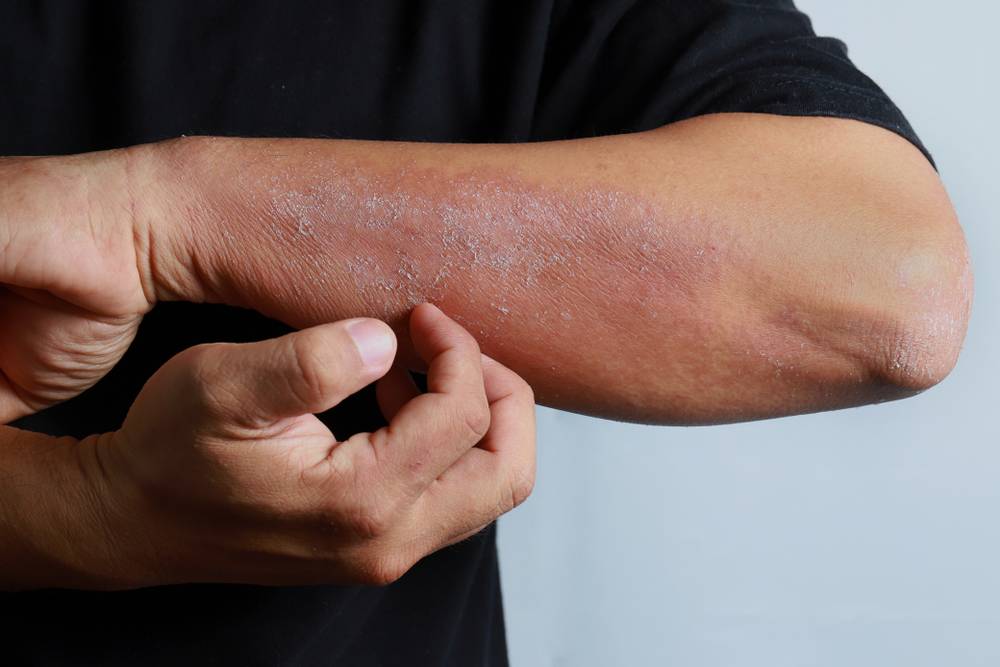 Что такое холодовой дерматит и экзема на руках и лице? способы лечения и профилактики патологии
