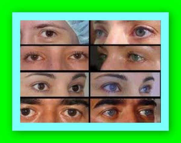 Черные глаза операция. Операция по изменению цвета глаз. Изменение цвета глаз лазером. Лазерная операция по изменению цвета глаз. Осветление цвета глаз лазером.