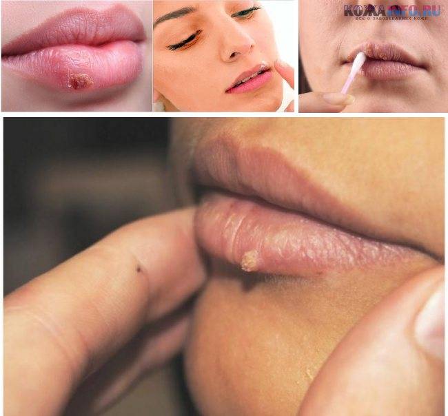 Папилломы на малых половых губах фото