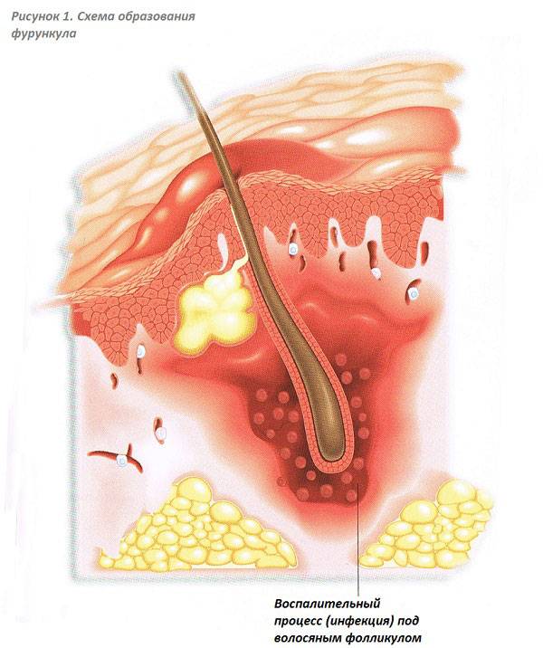 Фурункулы на теле: причины появления чирьев и способы лечения нарывов разными средствами