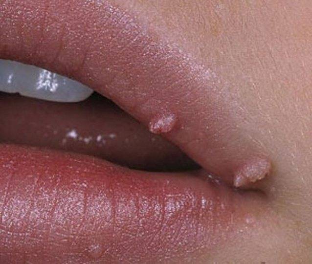 Папилломы на половых губах у женщин