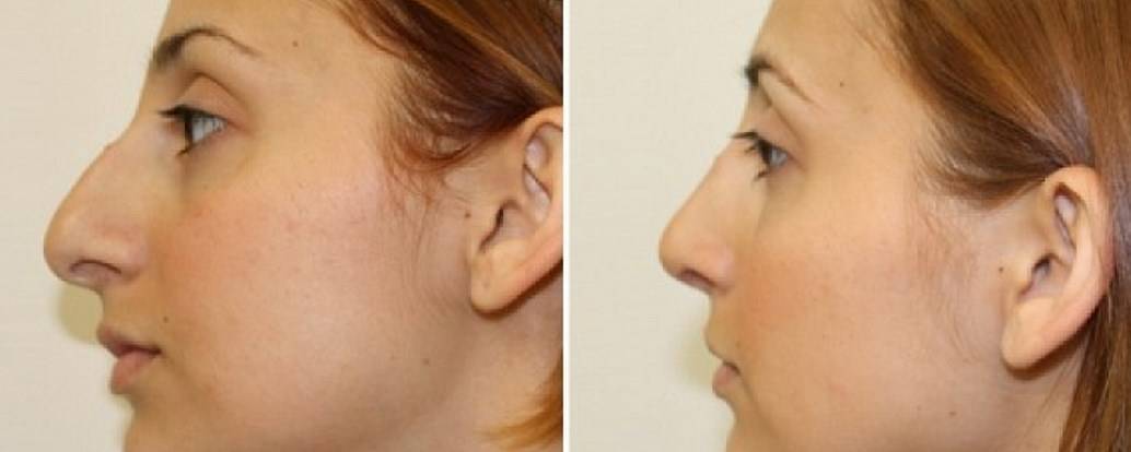 Горбинка на носу без операции. Ринопластика горбинки. Нос с горбинкой. Нос с горбинкой до и после операции.