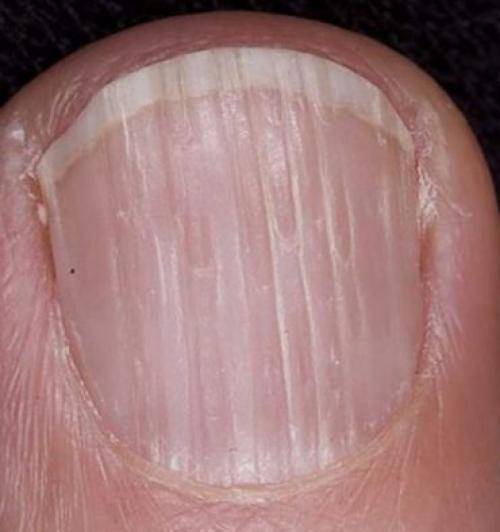 Причины волнистых ногтей на больших пальцах рук