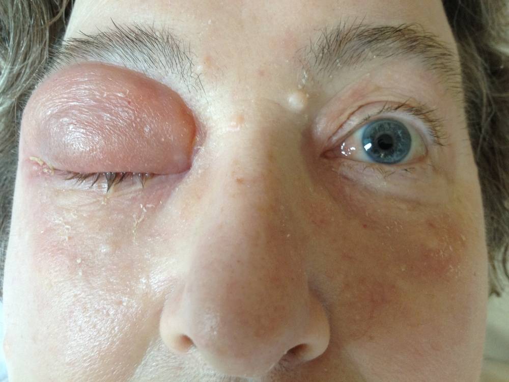 Фурункул на лице — как устранить симптомы заболевания?