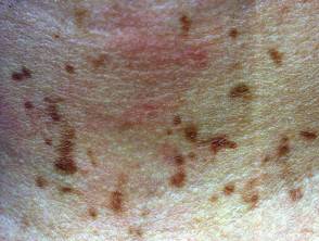Герпетиформный дерматит дюринга: причины, фото, лечение и диагностика