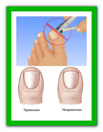 Как стричь ногти на ногах – рекомендации, техника исполнения.