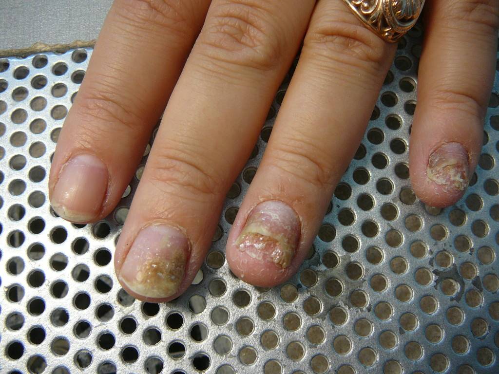 Болезни ногтей: виды и особенности лечения