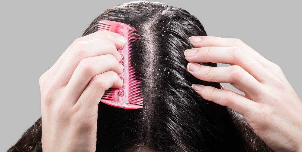Сухая кожа головы и перхоть: 15 шампуней на волосы - что делать и как избавиться, причины и лечение