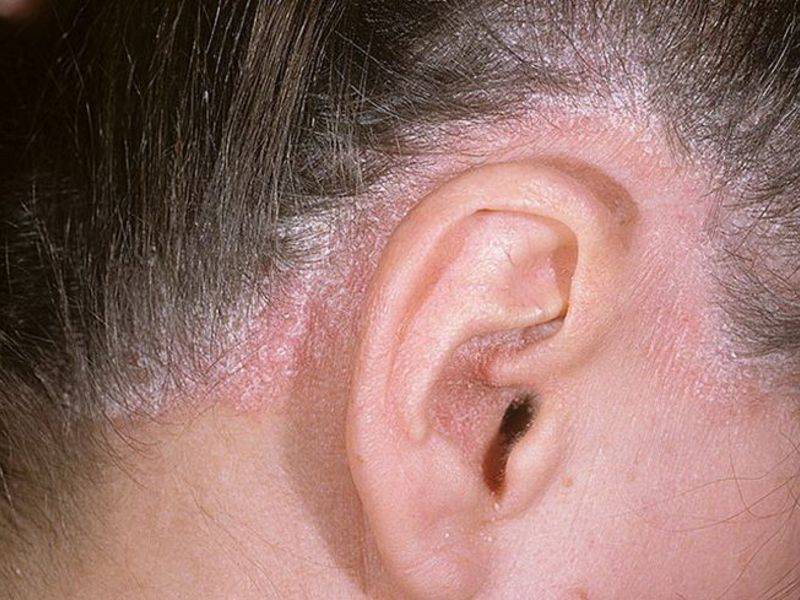 Перхоть за ушами – причины появления и способы избавления