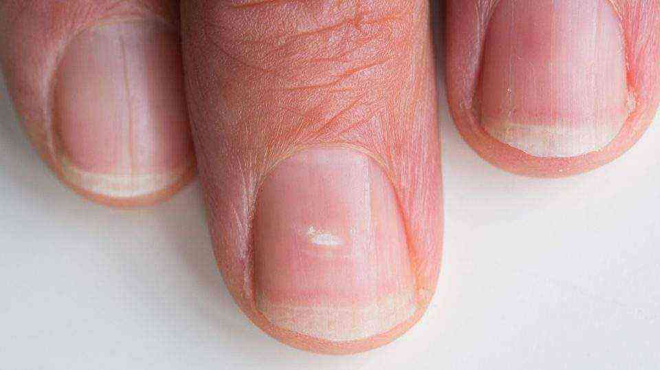 6 причин возникновения волнистости на ногтях